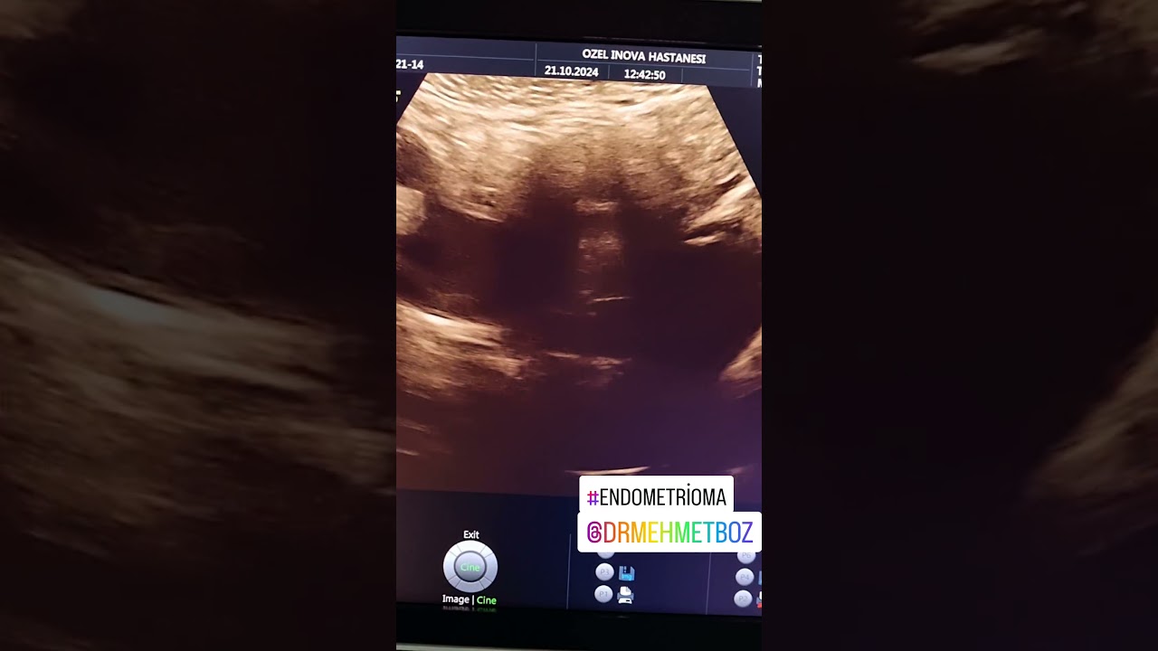 CA 125 YUKSEKLIGI GENC HASTALARDA. ENDOMETRIOMA ENDOMETRIOZIS.  DR. MEHMET BOZ