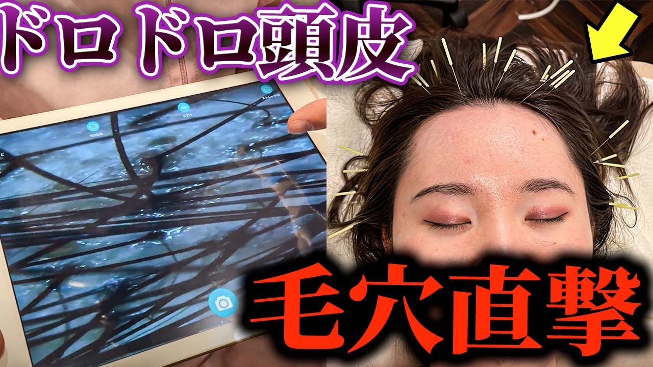【薄毛改善】20代女子も悩む髪のボリューム低下には鍼と洗浄したら髪が生き返る！　自宅でできるブラッシングとシャンプーで改善します【東京銀座　横浜元町　鍼灸院】