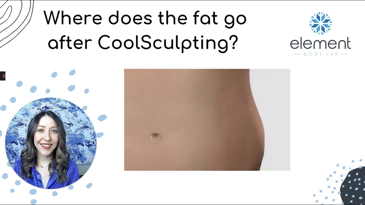 Where does the fat go after CoolSculpting? | Element Body Lab | Dallas, Tx