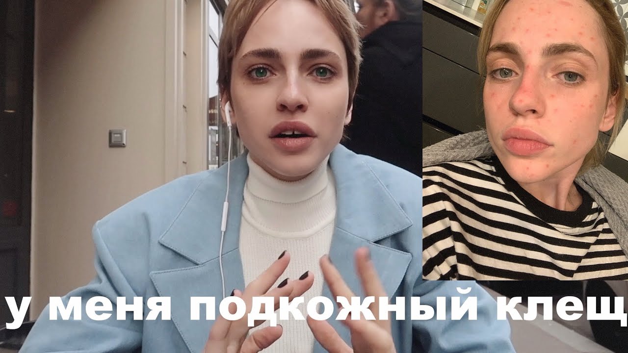 КАК Я ВЫЛЕЧИЛА КОЖУ? | подкожный клещ | модельная жесть