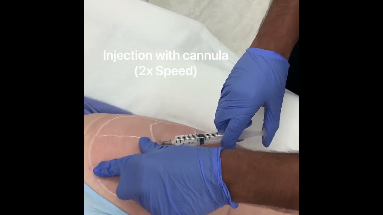 Non-surgical butt lift with Dr. Bashey