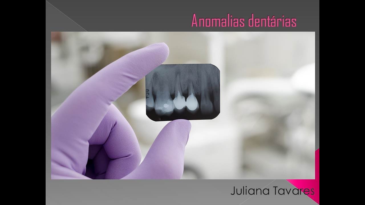 Anomalias dentárias