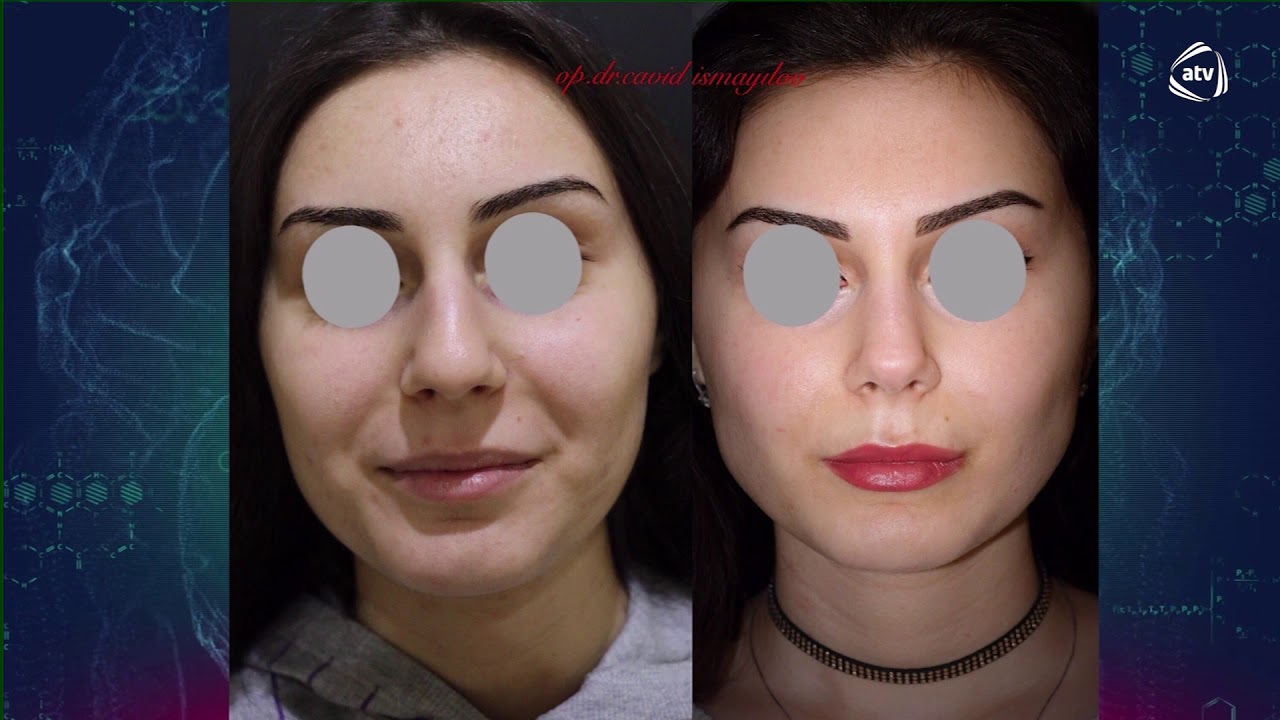 Dr.Cavid İsmayılov Atv Hekimsen.Qapali rinoplastika.Burun Çəpəri əməliyyatı