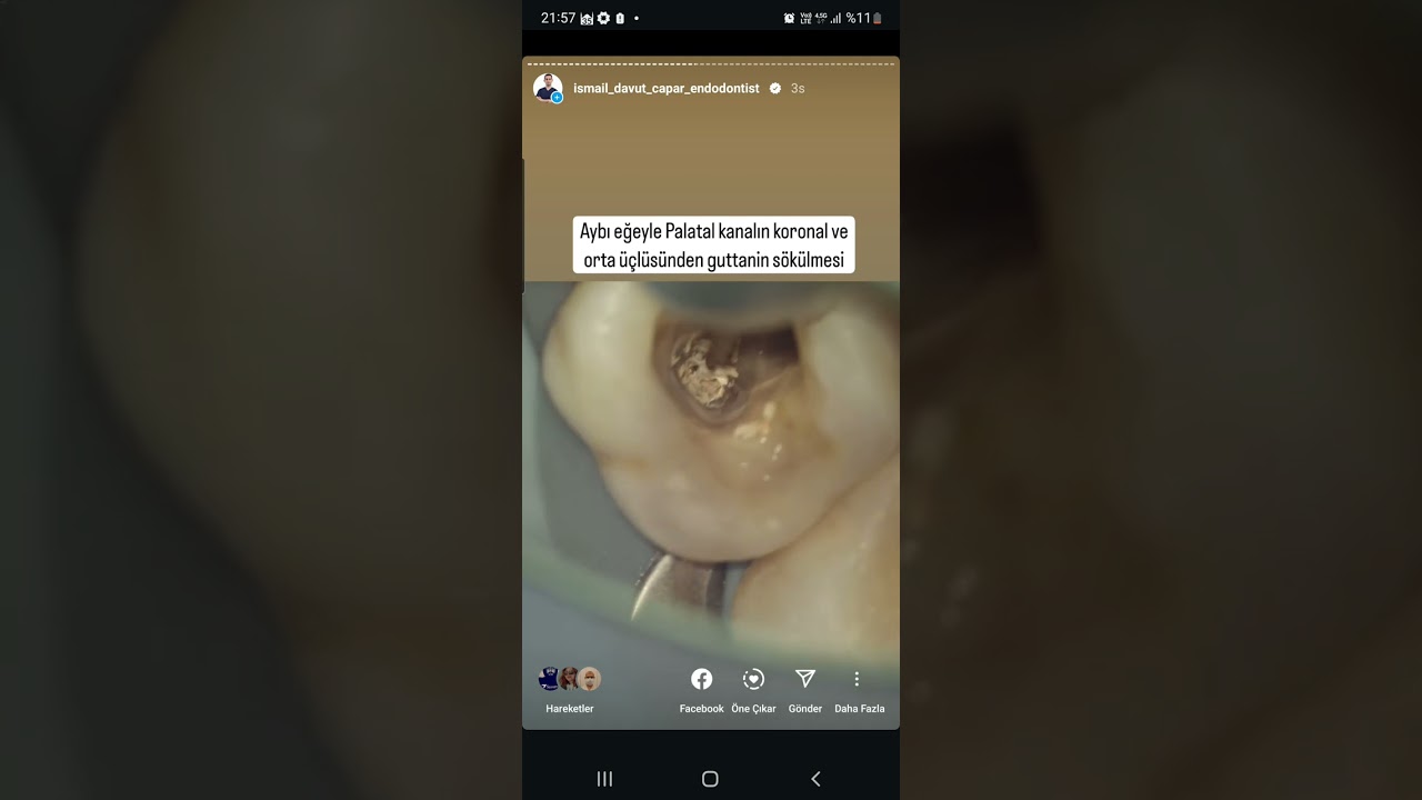 Retreatment işleminde nelere dikkat etmeliyiz?