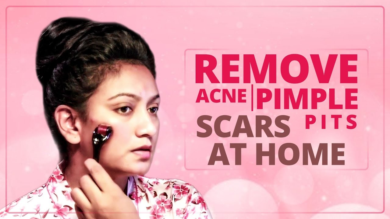 Remove Acne and Pimple Scars/Pits At Home || Ashtrixx