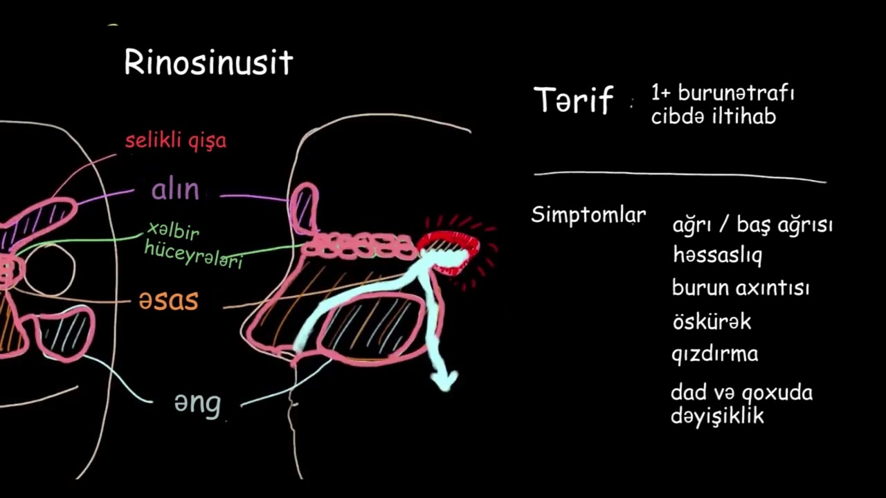 Sinusit nədir?