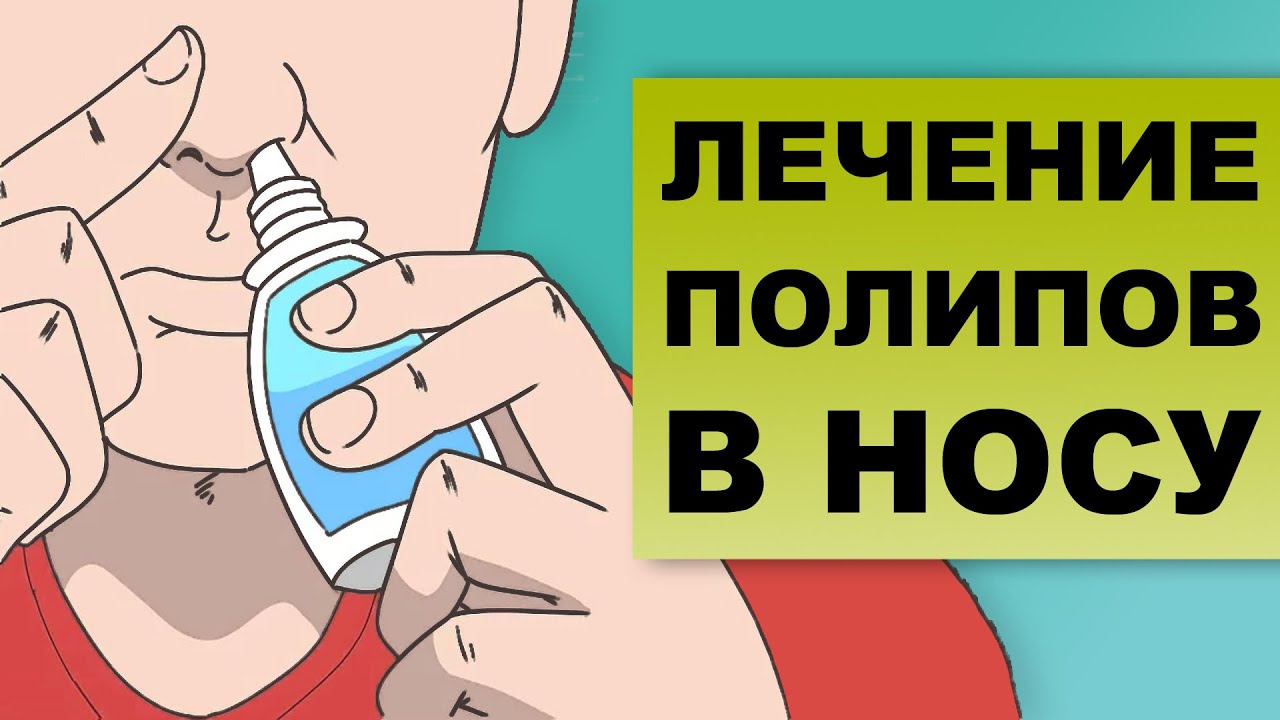ЛЕЧЕНИЕ ПОЛИПОВ В НОСУ