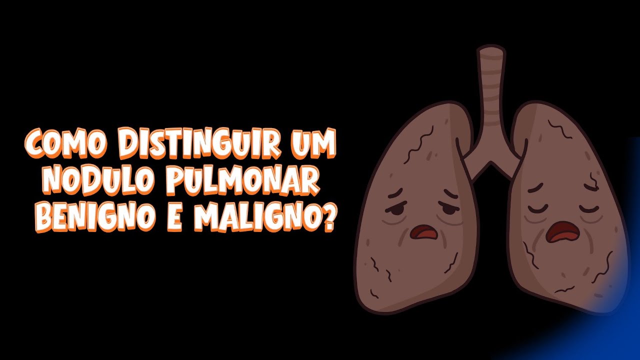 COMO DISTINGUIR UM NÓDULO PULMONAR BENIGNO E MALIGNO?