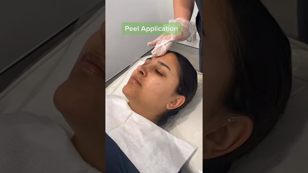 Peeled to Perfection! A step by step Chemical Peel treatment✨ | Results Laser Clinic #chemicalpeel