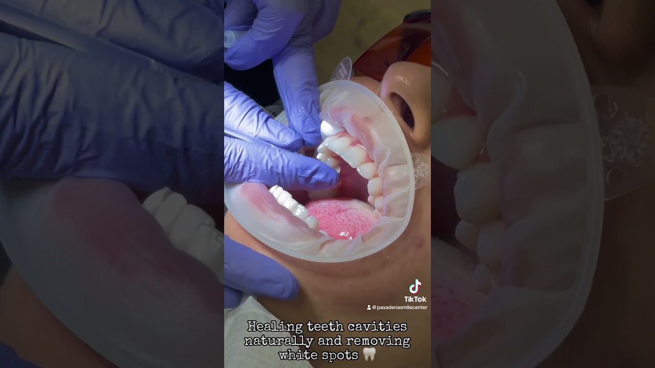 Healing teeth Naturally. Currodont, Remineralization of the teeth and removal of small cavities.