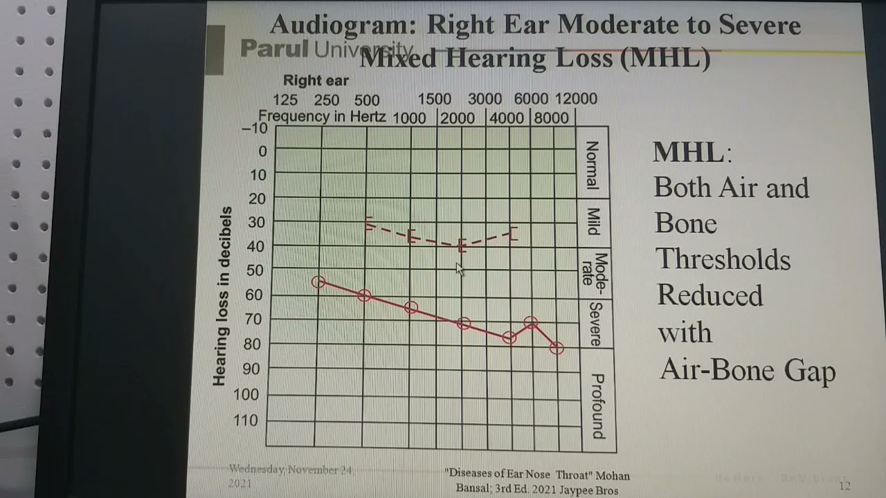 Pure Tone Audiogram  Part 1 - Interpretation -  Dr Mohan Bansal