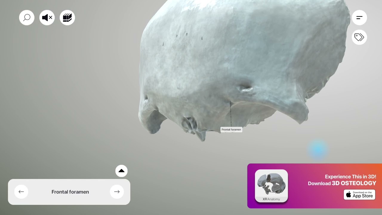 Frontal Bone - Frontal foramen