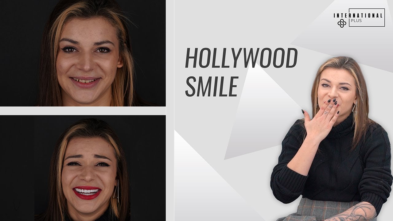 Smile Design Experience in Turkey | INTERNATIONAL PLUS