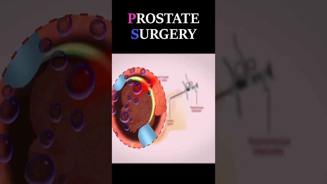 Przezcewkowa resekcja prostaty #szorty #prostata