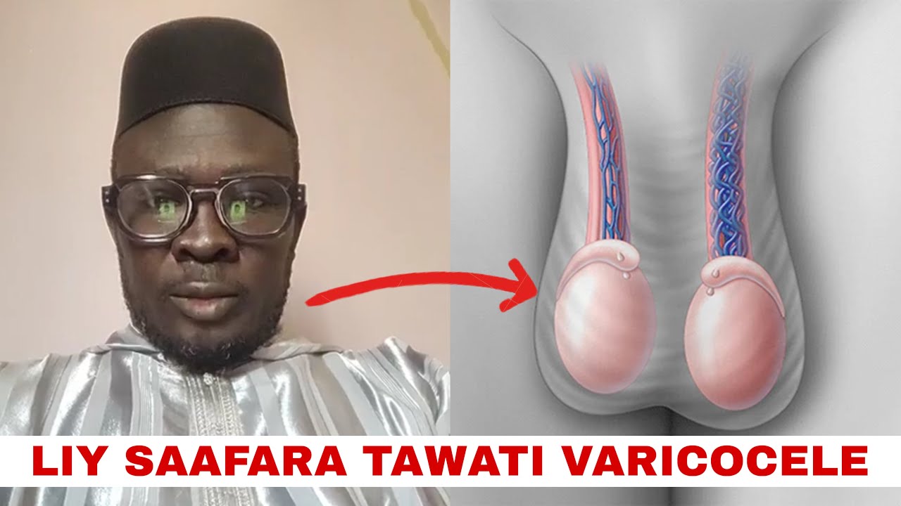 Ku amé fébaru varicocele te bëgg mu saafara wu déglul li Serigne Mor Asta Touré di wax
