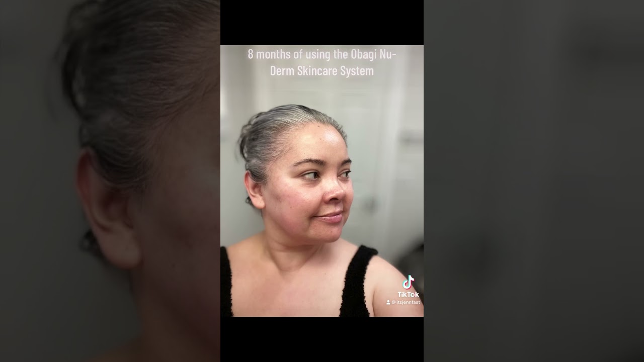 8 months of using the Obagi Nu-Derm Skincare system