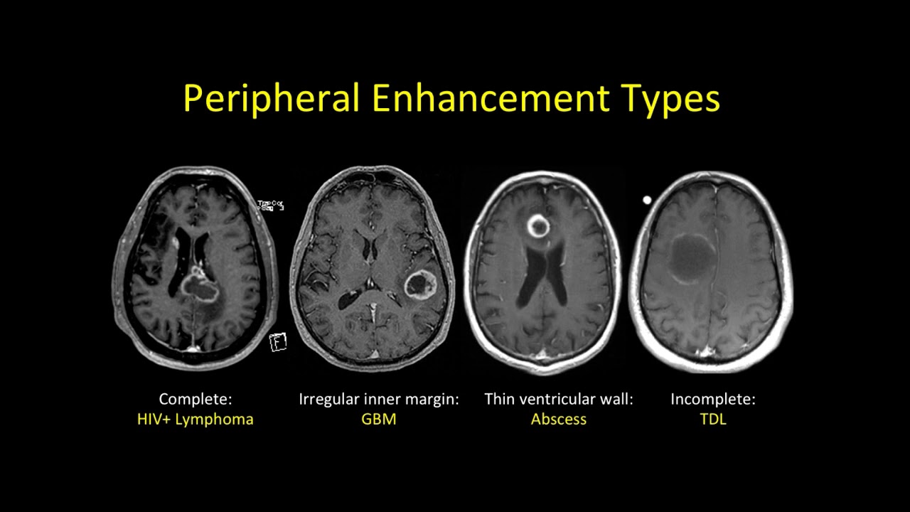 imaging of Multiple sclerosis