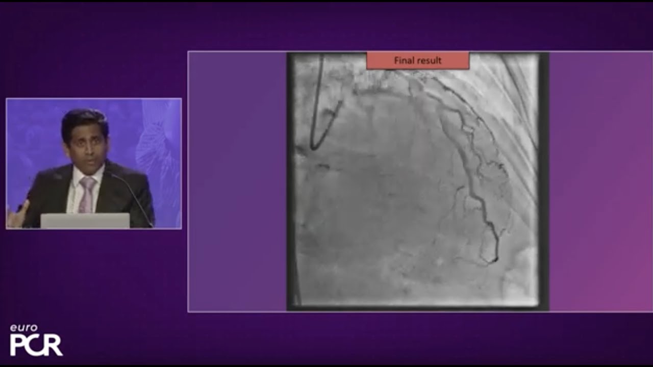 CAD treatment: sirolimus coated balloon and DES + DCB stent platform - EuroPCR 2023