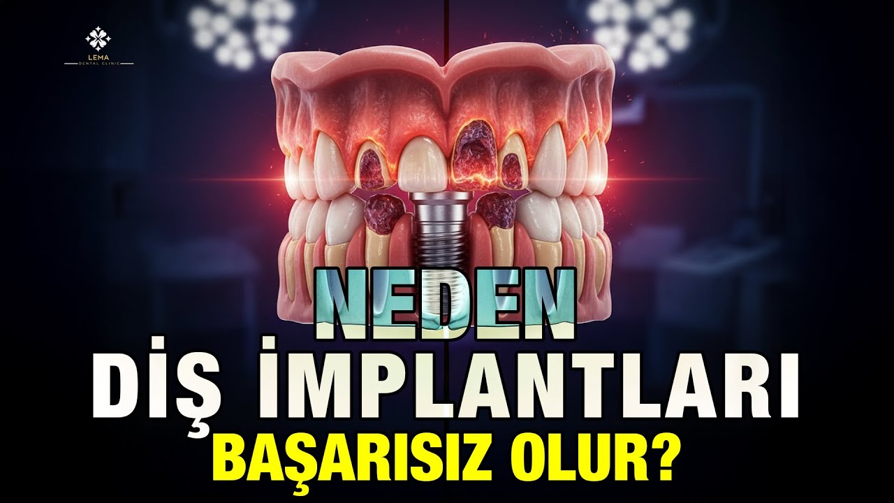 🤍 Вся правда о неудачной имплантации зубов - Lema Dental Clinic