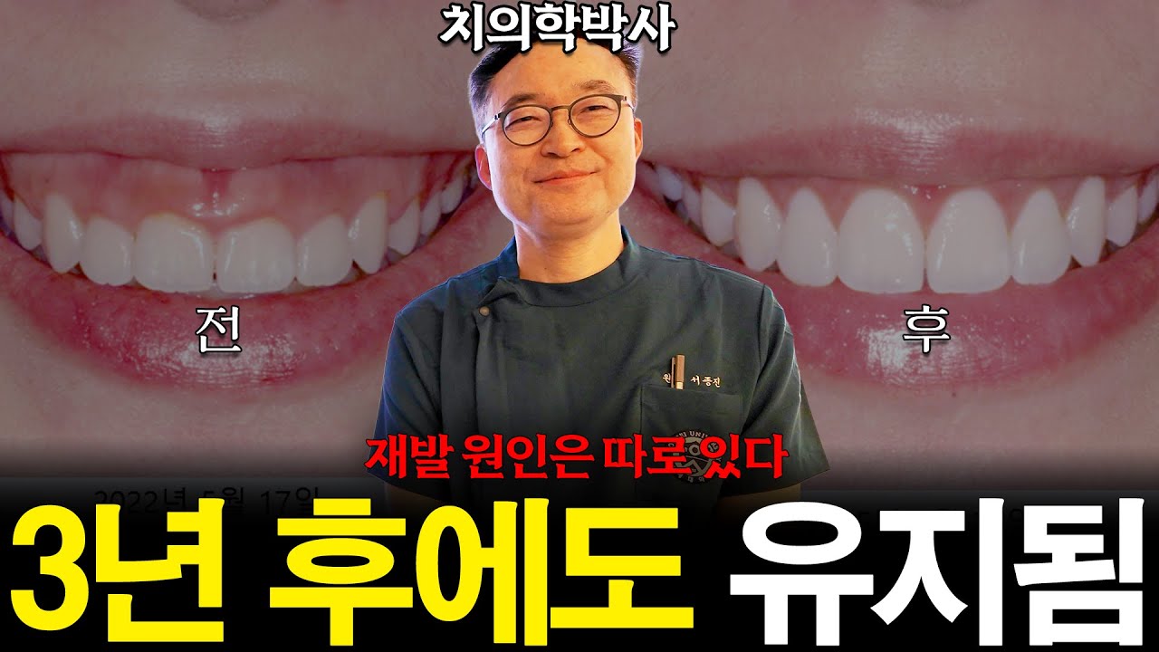 거미스마일 잇몸성형, 3년 후에도 재발 없는 이유｜치의학박사 서종진