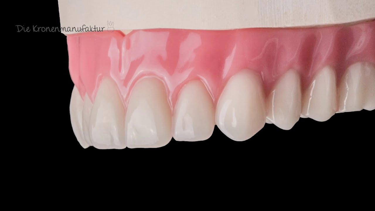 Gaumenfreie Prothese auf 4 Implantaten