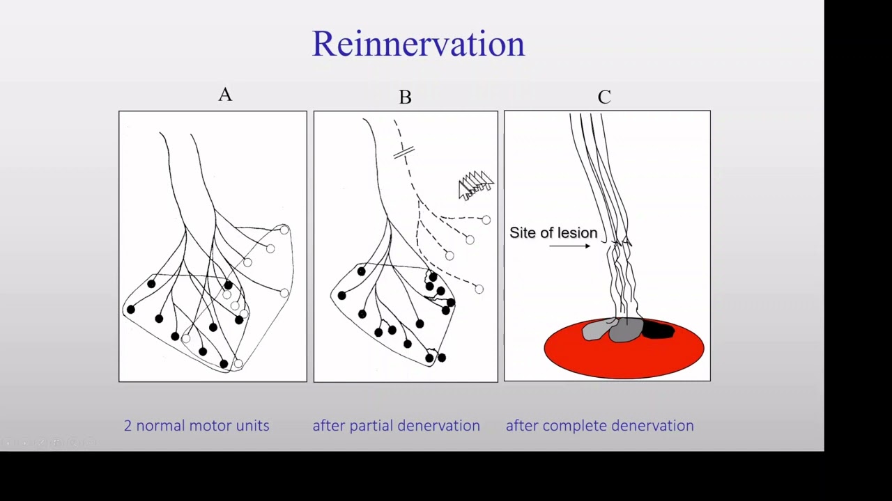 Electrophysiological findings in ALS