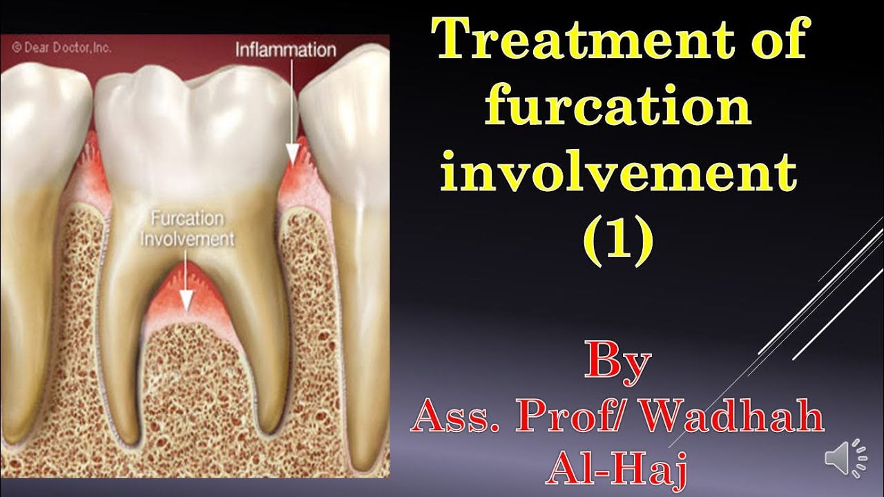 45-Periodontal surgery-14 (Furcation involvement-1)-Dr Wadhah Periodontology lectures.د/ وضاح الحاج