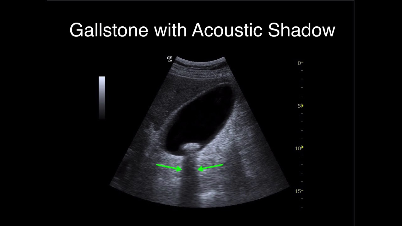 Right Upper Quadrant.