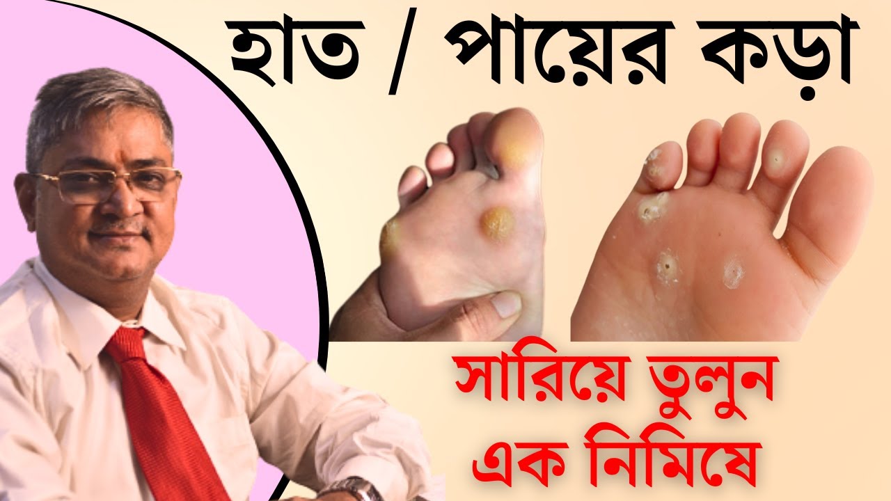 হাতে ও পায়ে কড়া সারিয়ে তুলুন এক নিমিষে | Foot Corn Remove without pain with in 5 minutes | cure corn