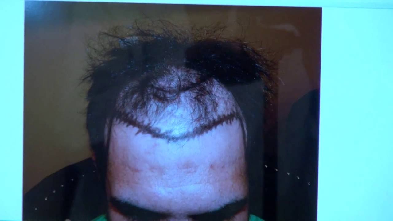 Los Gatos Hair Transplant 5,000 Grafts Results After 7 Months Dr. Diep www.mhtaclinic.com