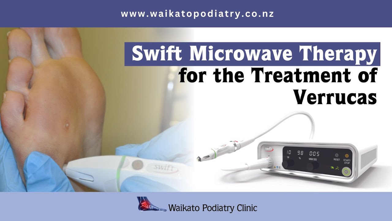 Swift Microwave Therapy for the treatment of Verrucas | Andrew Jones | Waikato Podiatry