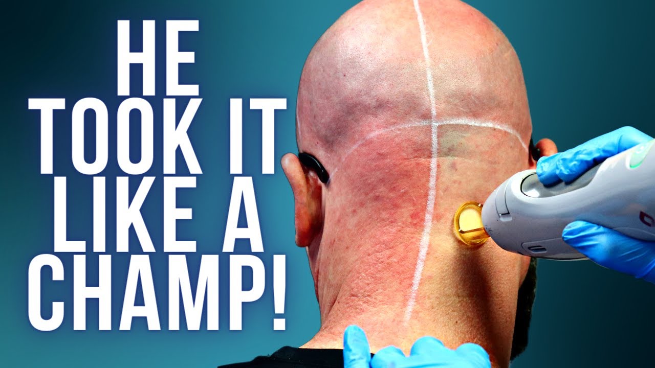 CANDELA GENTLEMAX PRO: COMPLETE LASER HAIR REMOVAL FOR SCALP & MORE