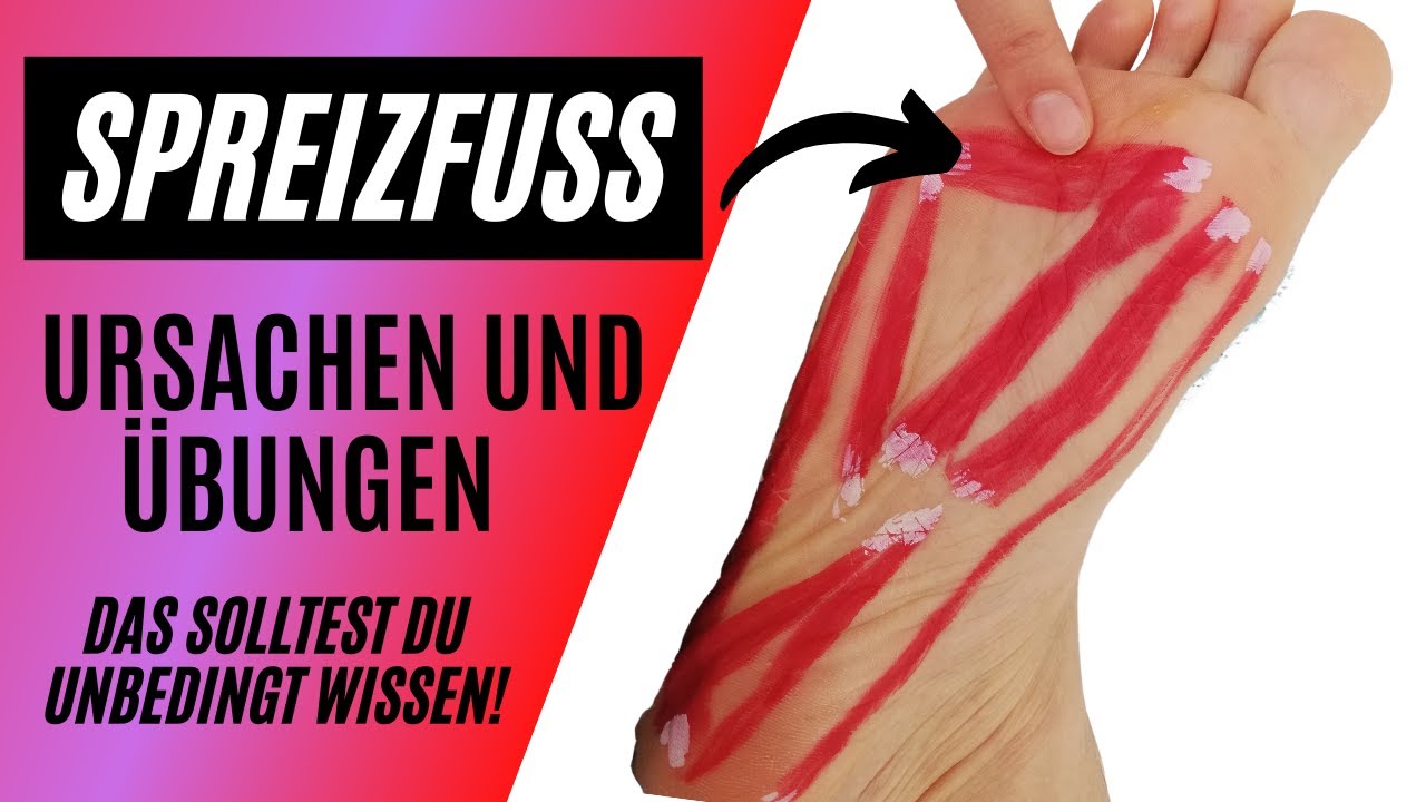 Spreizfuß | DAS SOLLTEST DU WISSEN!!!