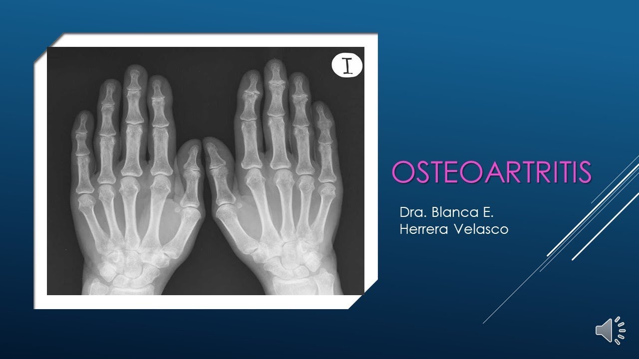 Osteoartritis