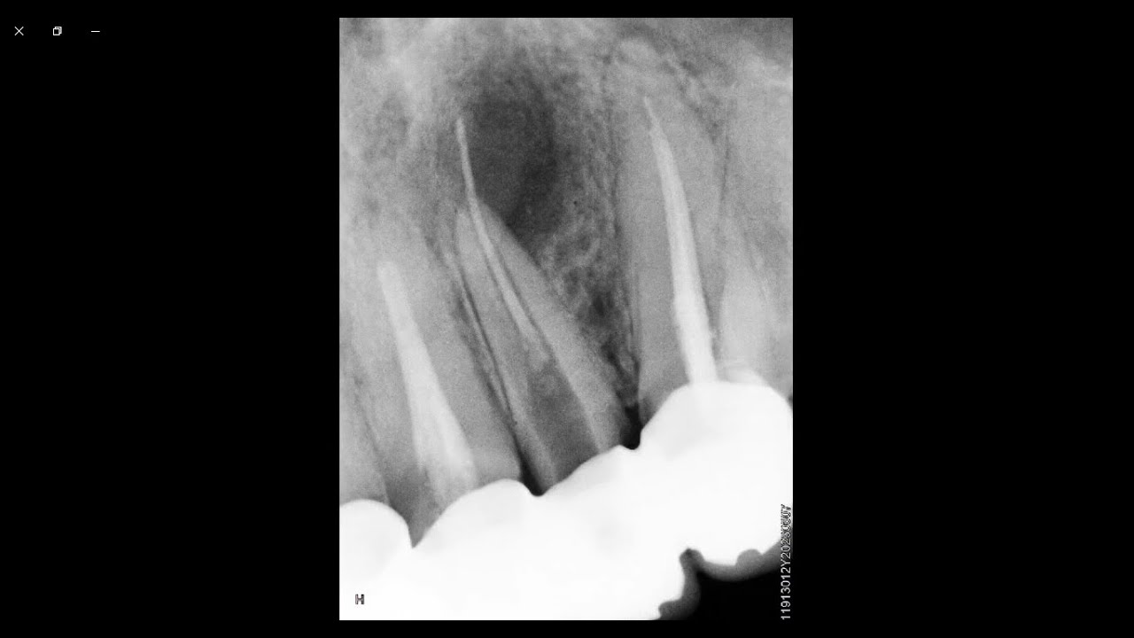 حالة سريرية open apex + over extended gutta percha cone removing + Mta obturation