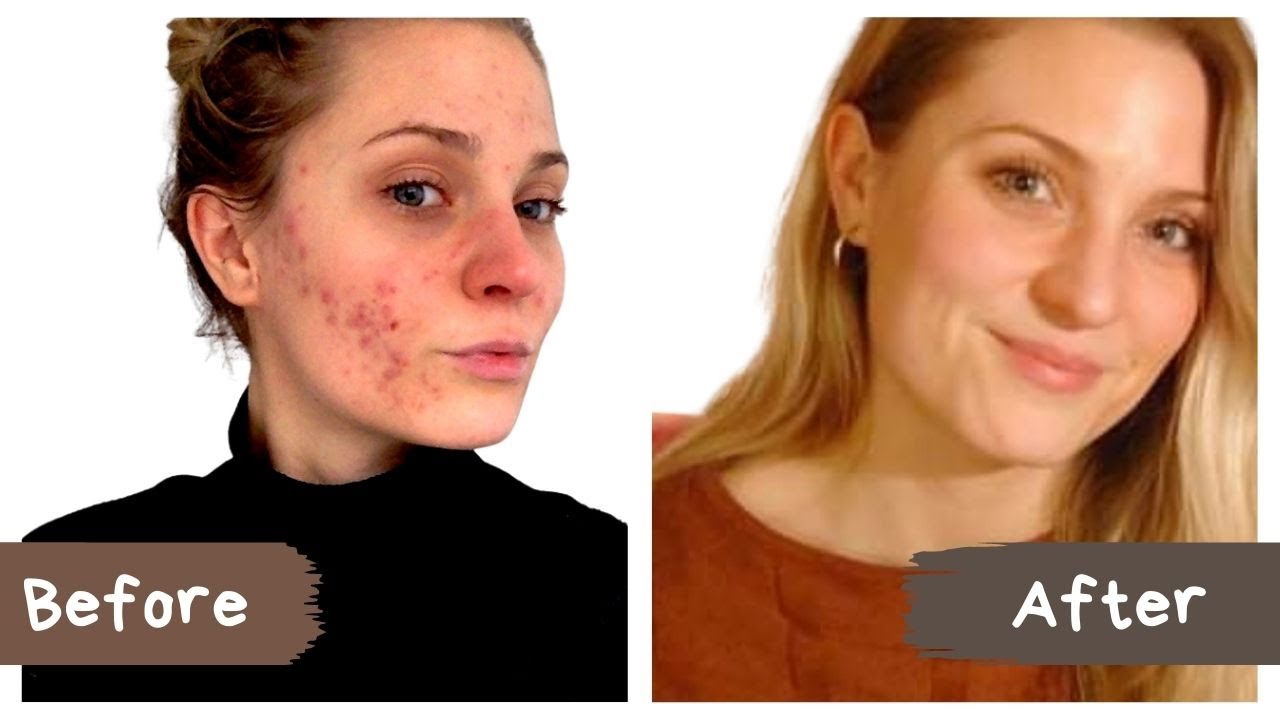 How I Finally Healed my Acne (And how you can too)