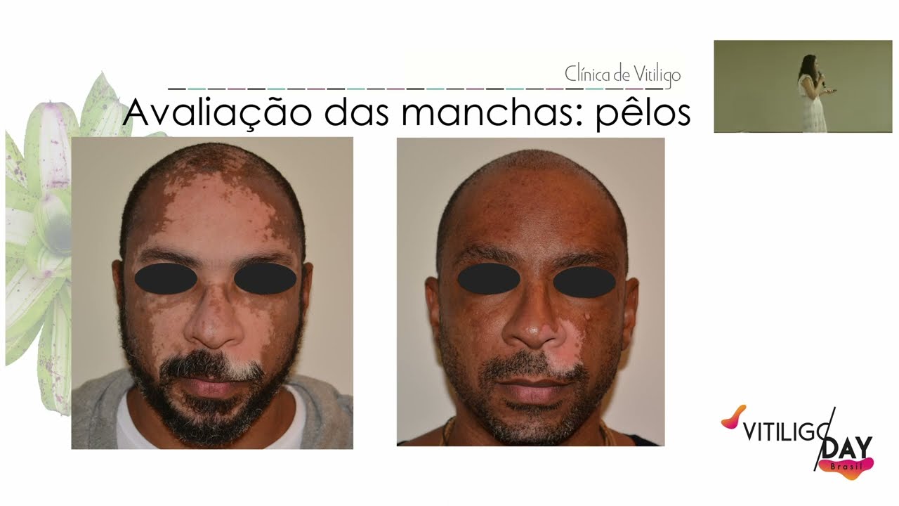 Vitiligo Day Brasil 2022 -  Tratamento de Vitiligo | Dra. Patricia Paludo