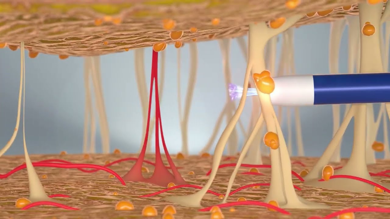 Argo Plasma Animation