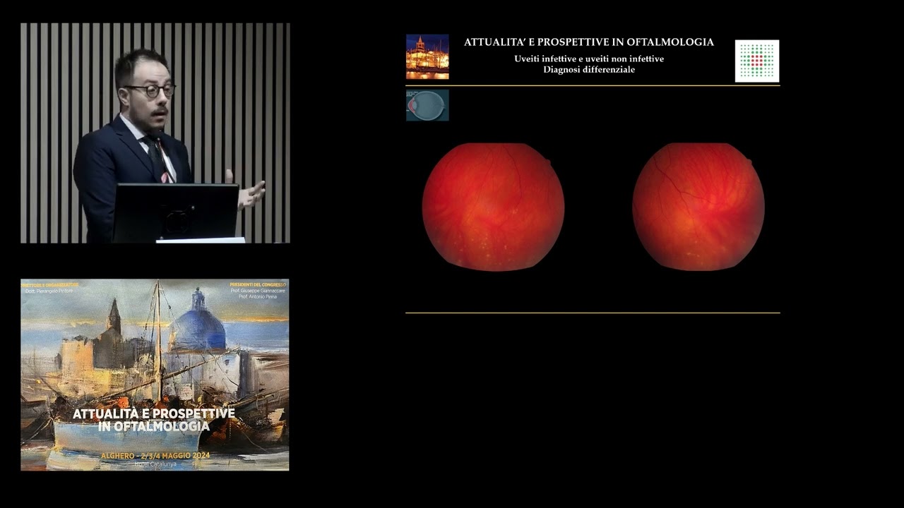 Uveiti infettive e non infettive, diagnosi differenziale - Jacopo Marzano