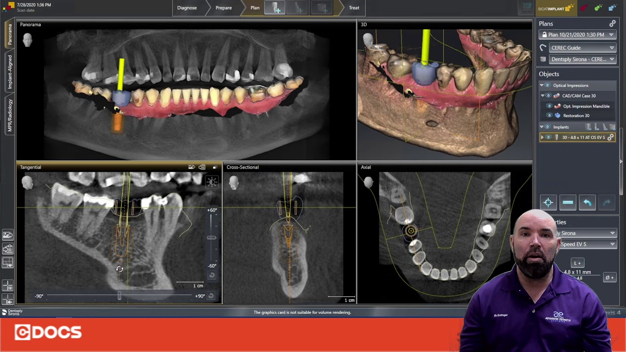 Tip of the Day: Implant Aligned View