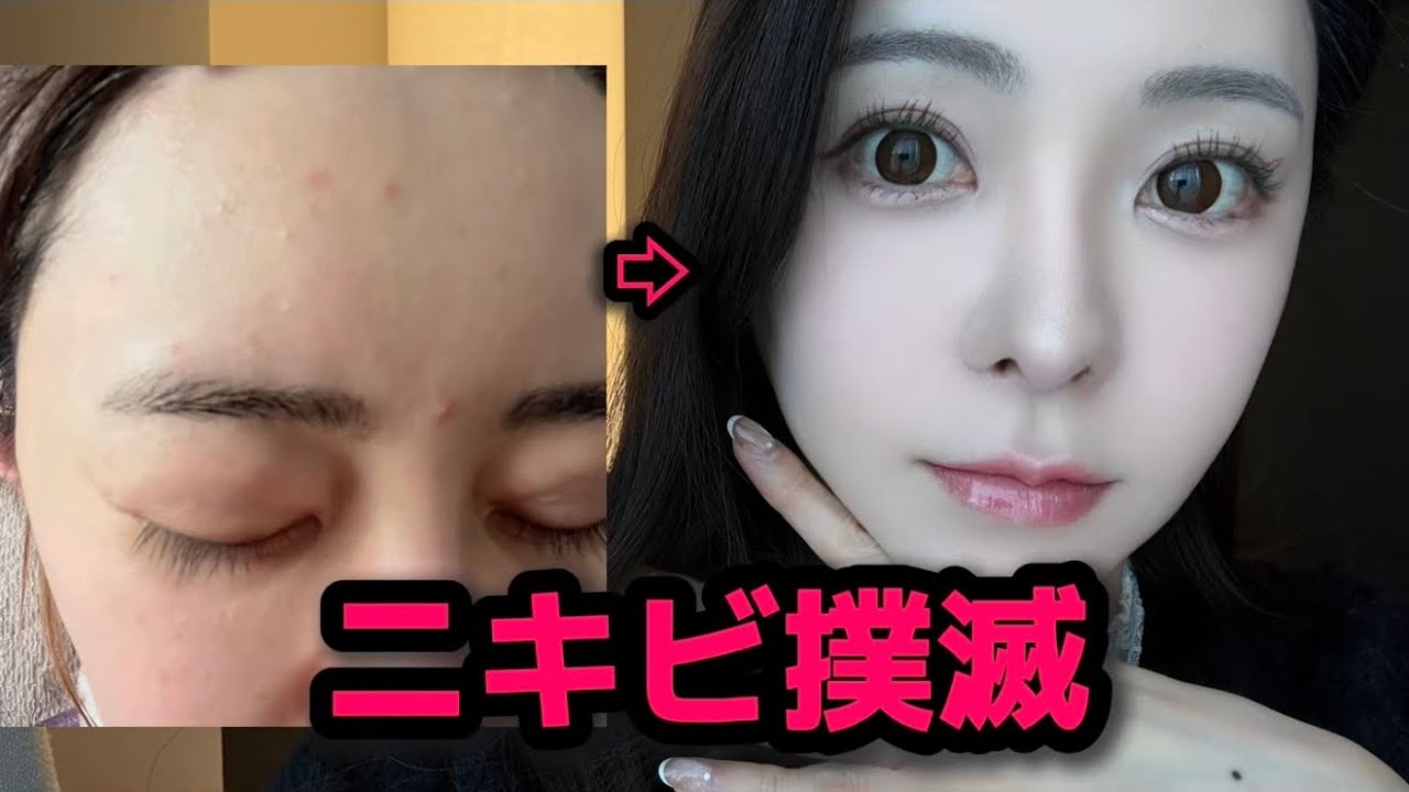 【ニキビ撲滅】ニキビだらけだった肌を最速で撲滅させた裏ワザ✨