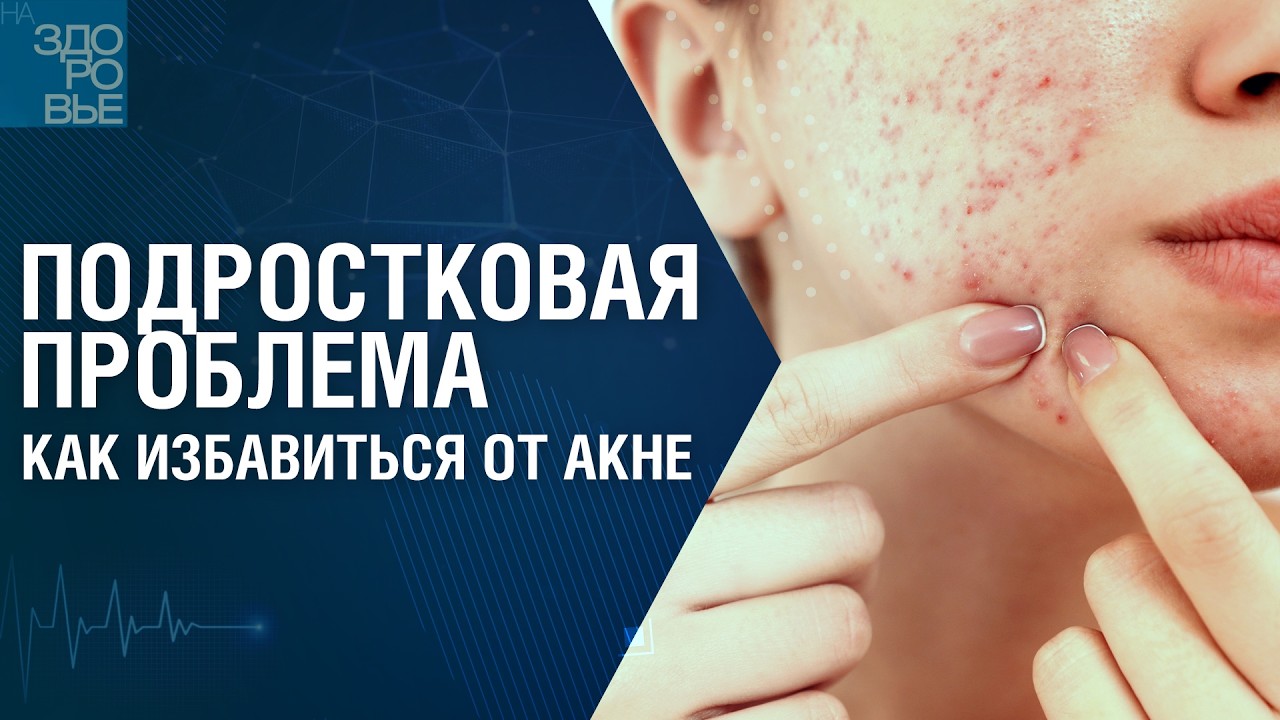 Подростковая проблема. Как избавиться от акне. На здоровье 28.02.2026