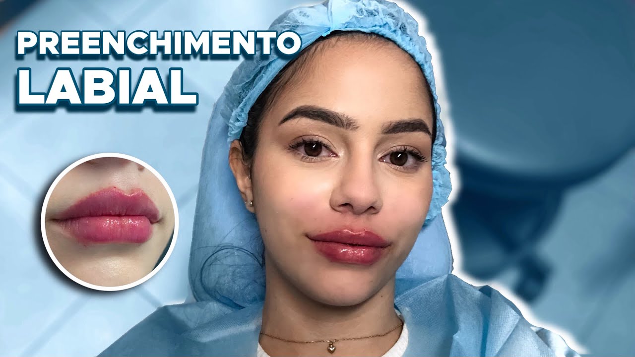 PREENCHIMENTO LABIAL | Como é feito (dor, inchaço, recuperação, antes e depois, pós) MOSTREI TUDO!!!
