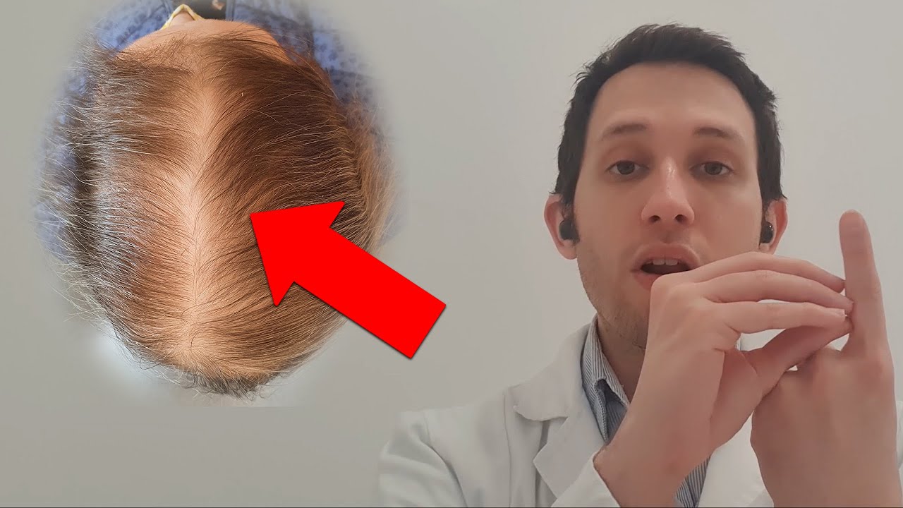 ¿Cuándo se queda una mujer calva?