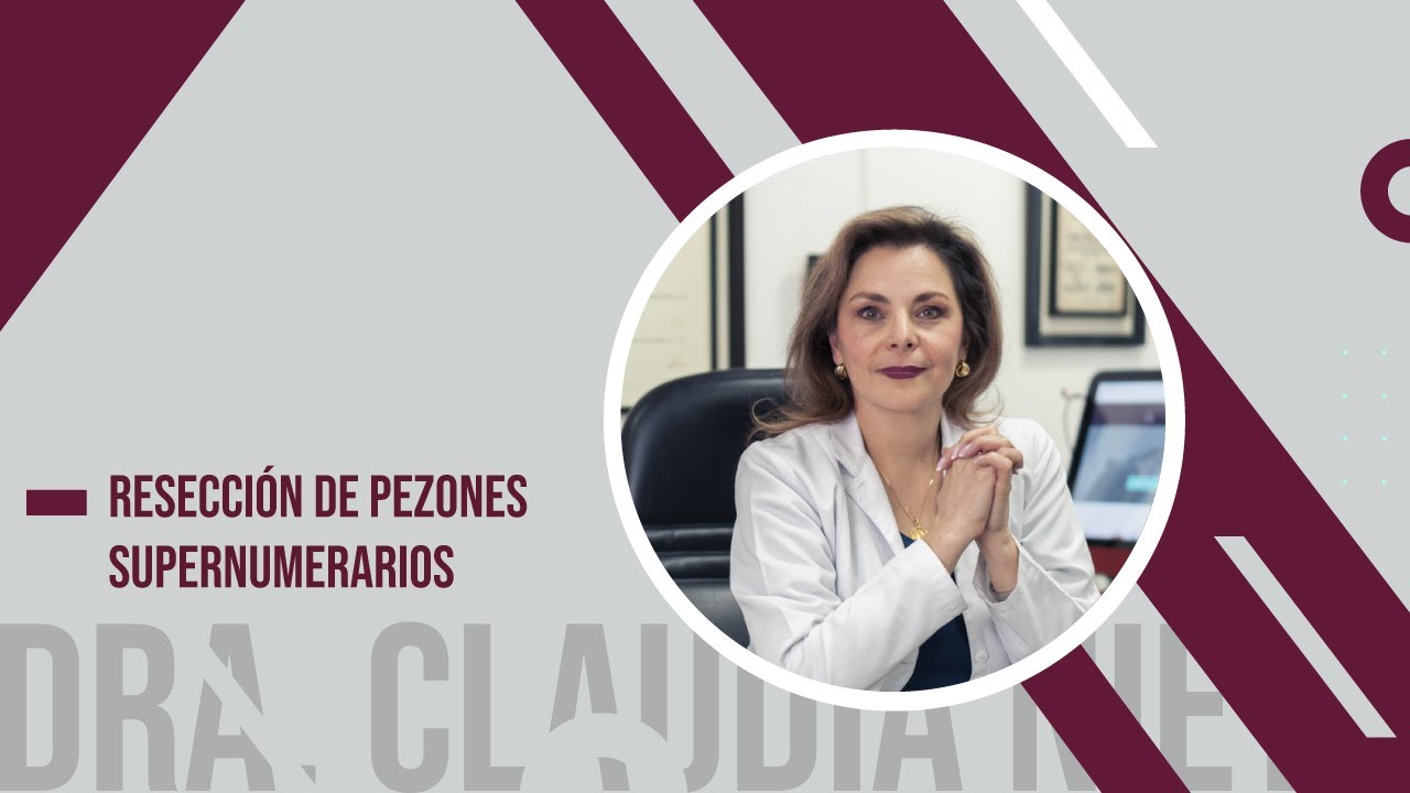 RESECCI&Oacute;N DE PEZONES SUPERNUMERARIOS O POLITELIA - DRA. CLAUDIA NIETO