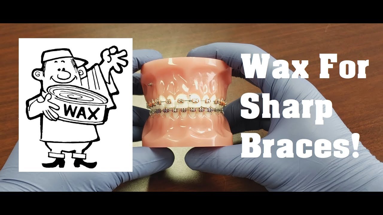 Tutorial: How to put wax on braces - For poking wires, hooks, broken brackets, etc.
