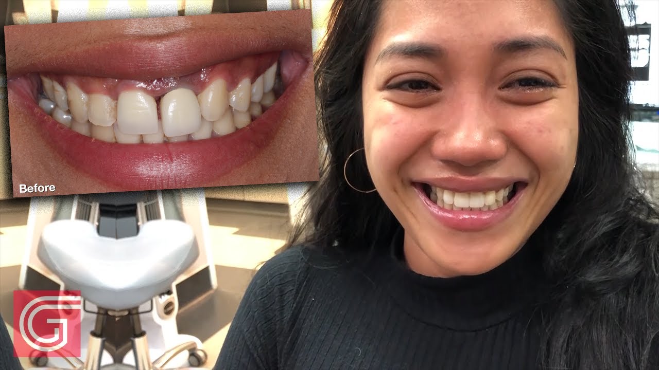 Placing #BruxZir Esthetic in the ANTERIOR #7 - #11: Part 1 of 3
