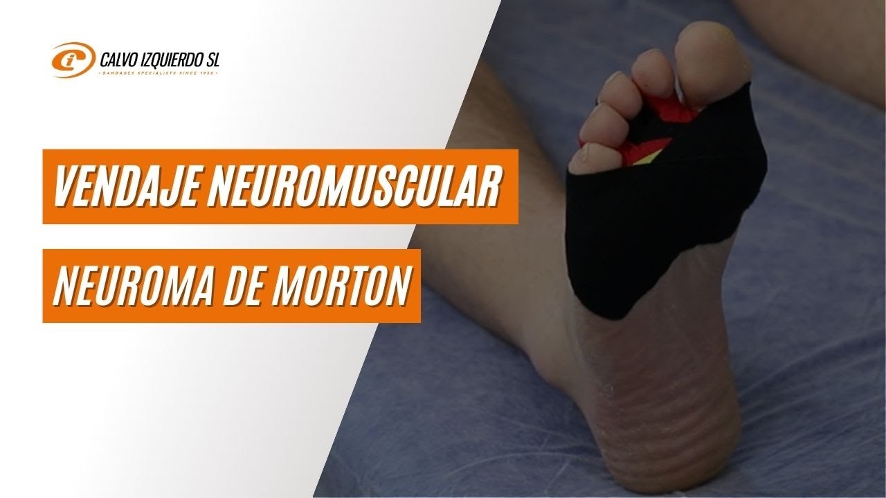 Vendaje neuromuscular para el neuroma de morton