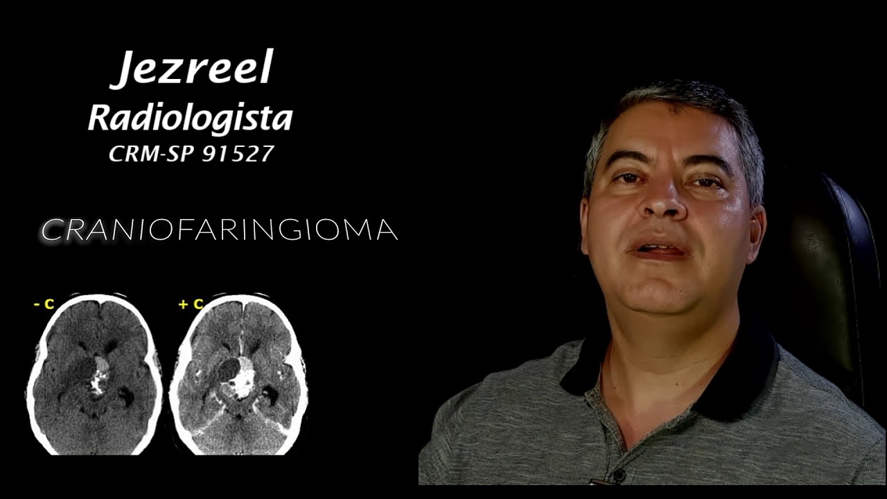 Craniofaringioma