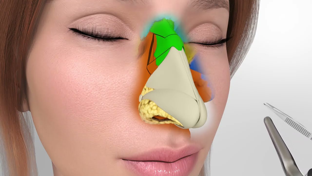 SINGLE HORIZONTALOSTEOTOMY TECHNIQUE INSEPTO-RHINOPLASTY 3D